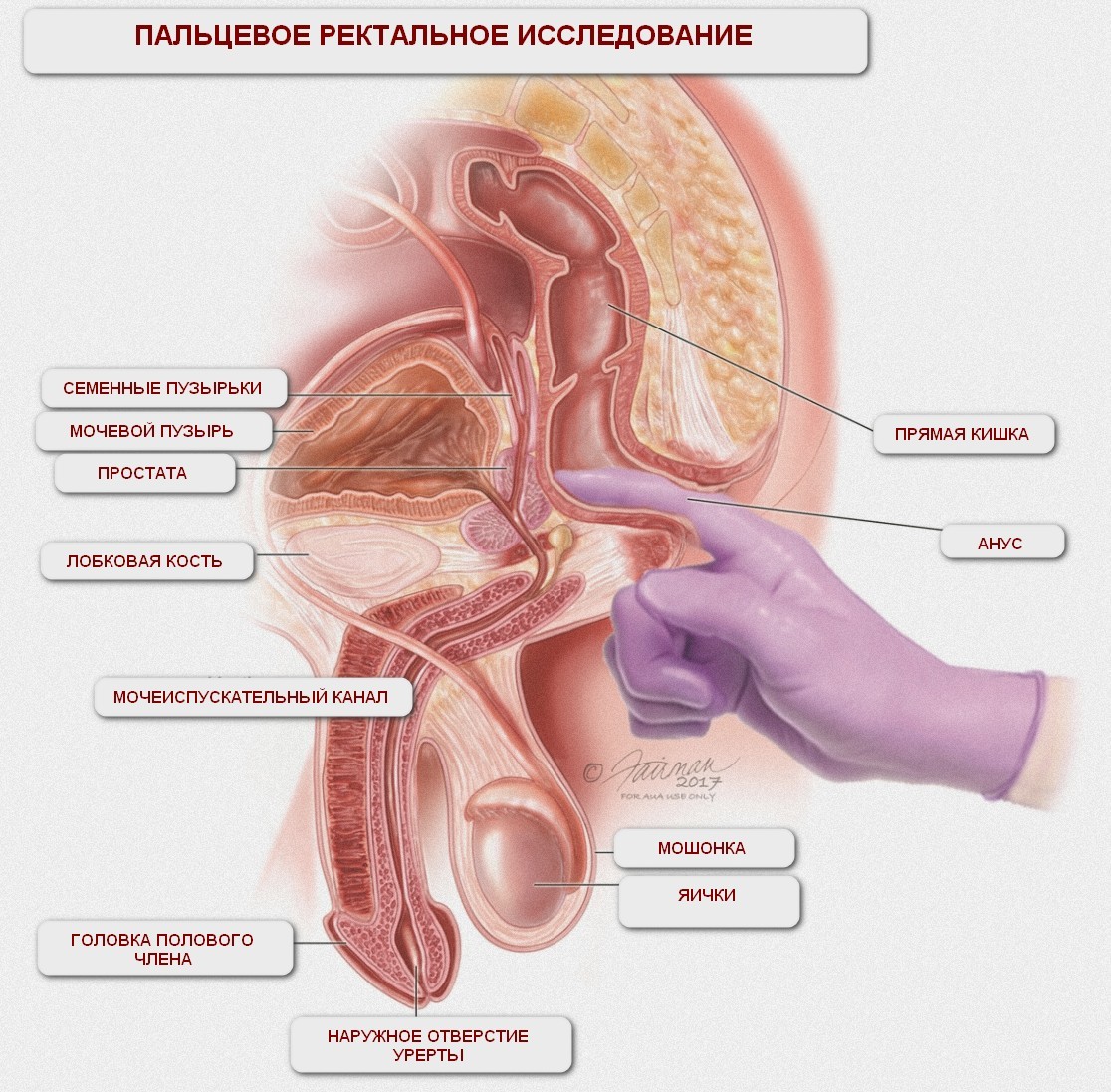 Аденома простаты (предстательной железы) – Лечение и диагностика в Киеве