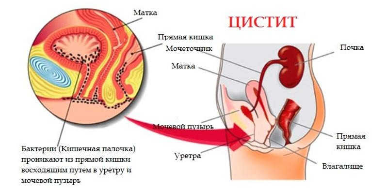 Воспаление мочевого пузыря у женщин: симптомы, причины и эффективные методы лечения