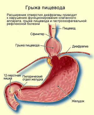 Почему стоит сделать операцию грыжи пищеводного отверстия диафрагмы в краснодарской клинике WMT