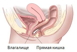 Лапароскопическая фиксация матки при ее опущении или выпадении